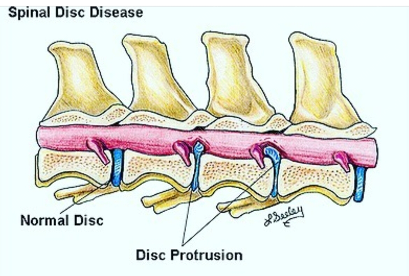 Экструзия межпозвоночного диска у собак. Протрузия экструзия грыжа. Экструзия межпозвонкового диска у собак. Межпозвоночный диск собаки.